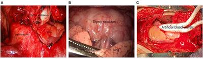 Pathological Features and Prognosis of Thymoma With or Without Myasthenia Gravis